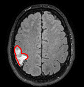 glioma